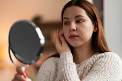 Comment reconnaître l'acné hormonale ?
